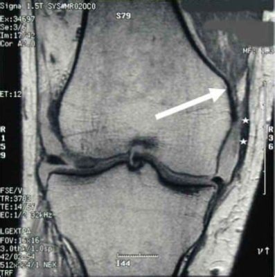 Does an X-ray Show Torn Ligaments?