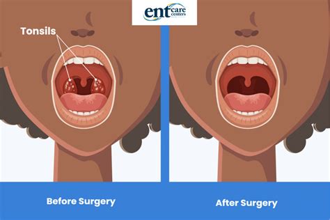 Does Removing Tonsils Help with Snoring? And Can It Make You Dream of Flying Elephants?