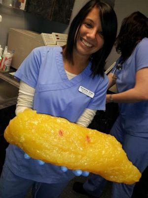 What Does 80 Pounds of Fat Look Like? And Why Does It Remind Me of a Balloon Animal?